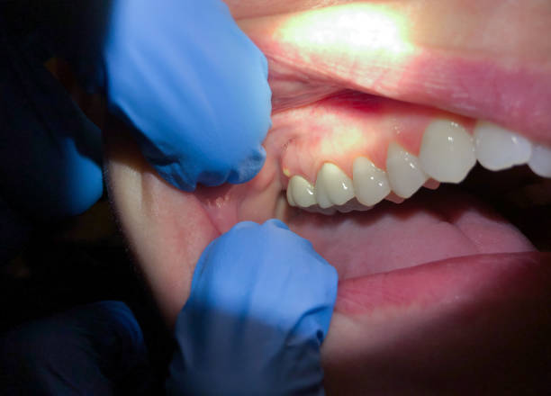 Best Emergency Tooth Extraction  in Mount Gilead, NC